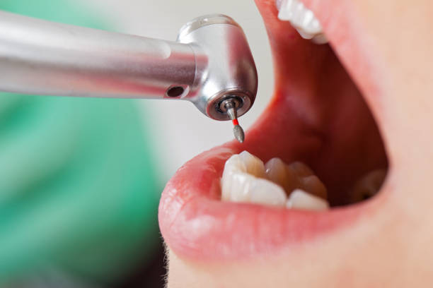 Best Emergency Dental Care for Broken or Chipped Teeth in South Creek, WA